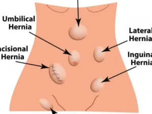 hernia-500x300