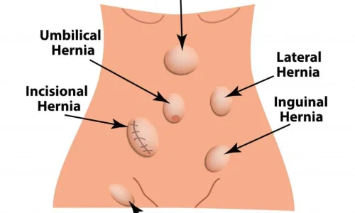 hernia-500x300