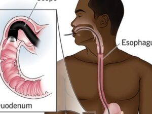uppergiendoscopy-500x300