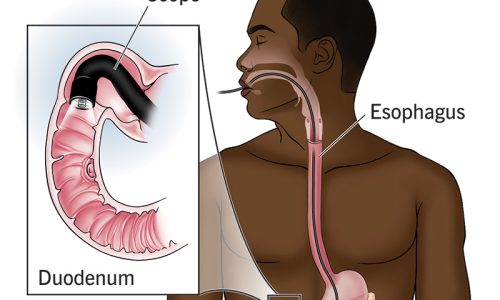 uppergiendoscopy-500x300
